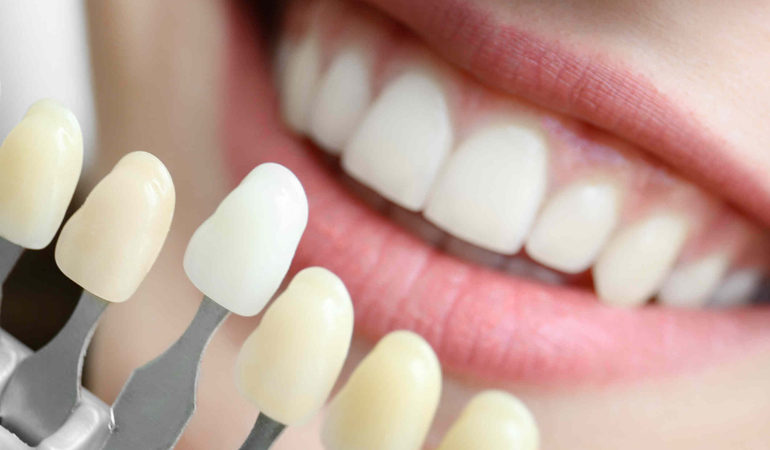 Smile beautified by Cosmetic dentistry