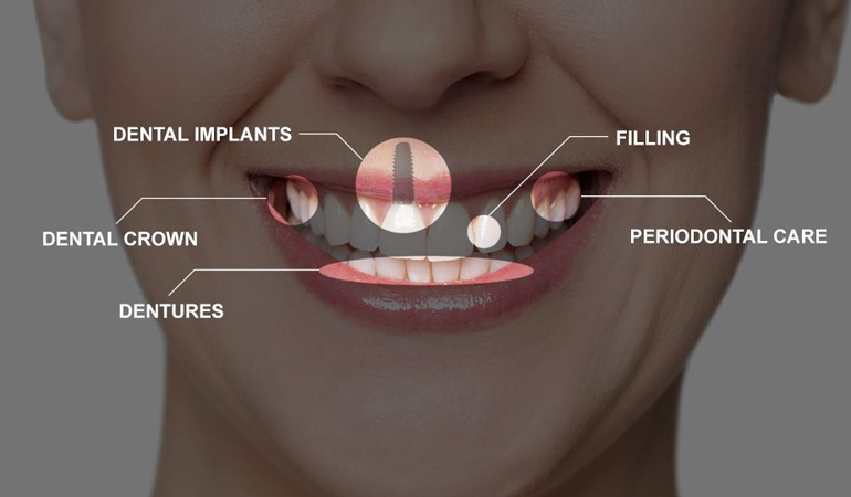Things You Should Know About Full Mouth Rehabilitation
