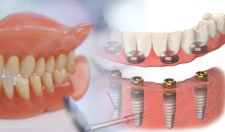 Permanent Denture Options – Pros & Cons