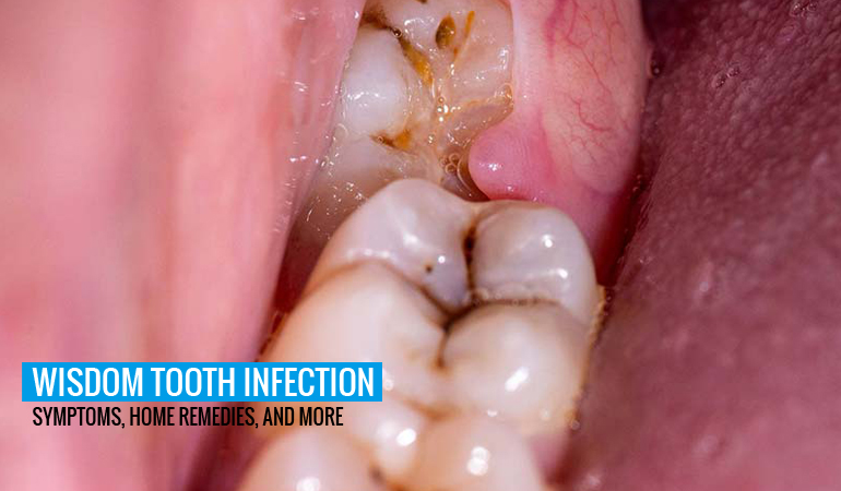 Wisdom Tooth Infection: Symptoms, Home Remedies, and More