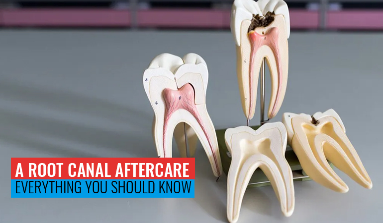 A Root Canal Aftercare: Everything You Should Know