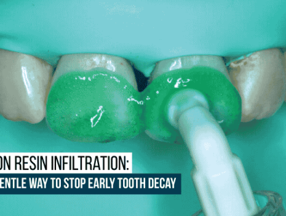 Icon Resin Infiltration: A Gentle Way to Stop Early Tooth Decay