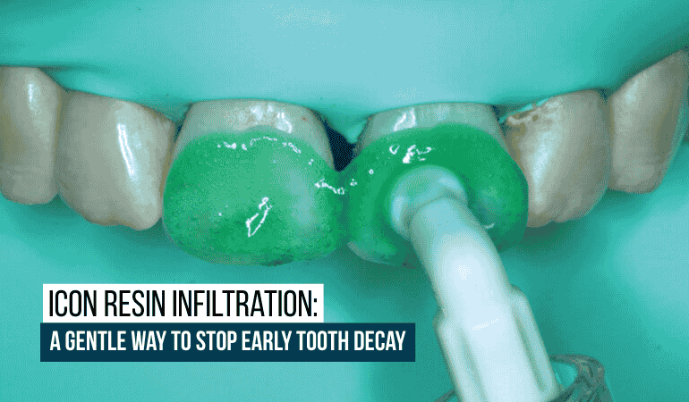 Icon Resin Infiltration: A Gentle Way to Stop Early Tooth Decay