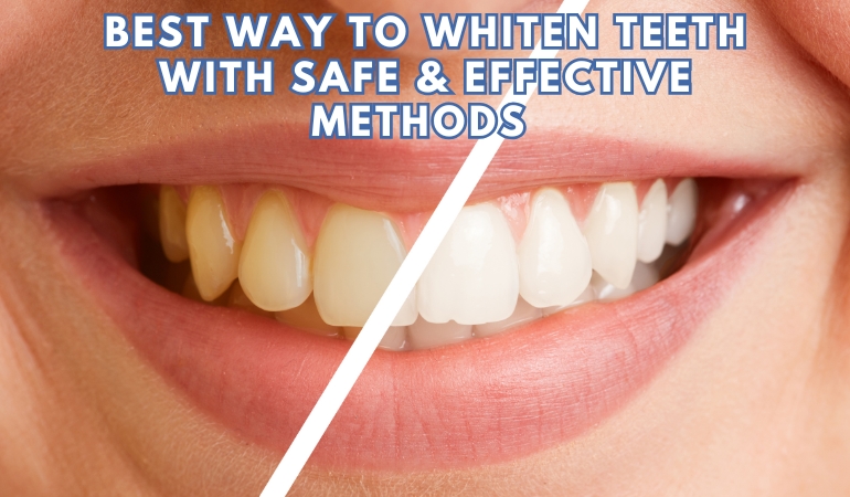 What Is the Best Way to Whiten Teeth? Safe & Effective Methods Explained