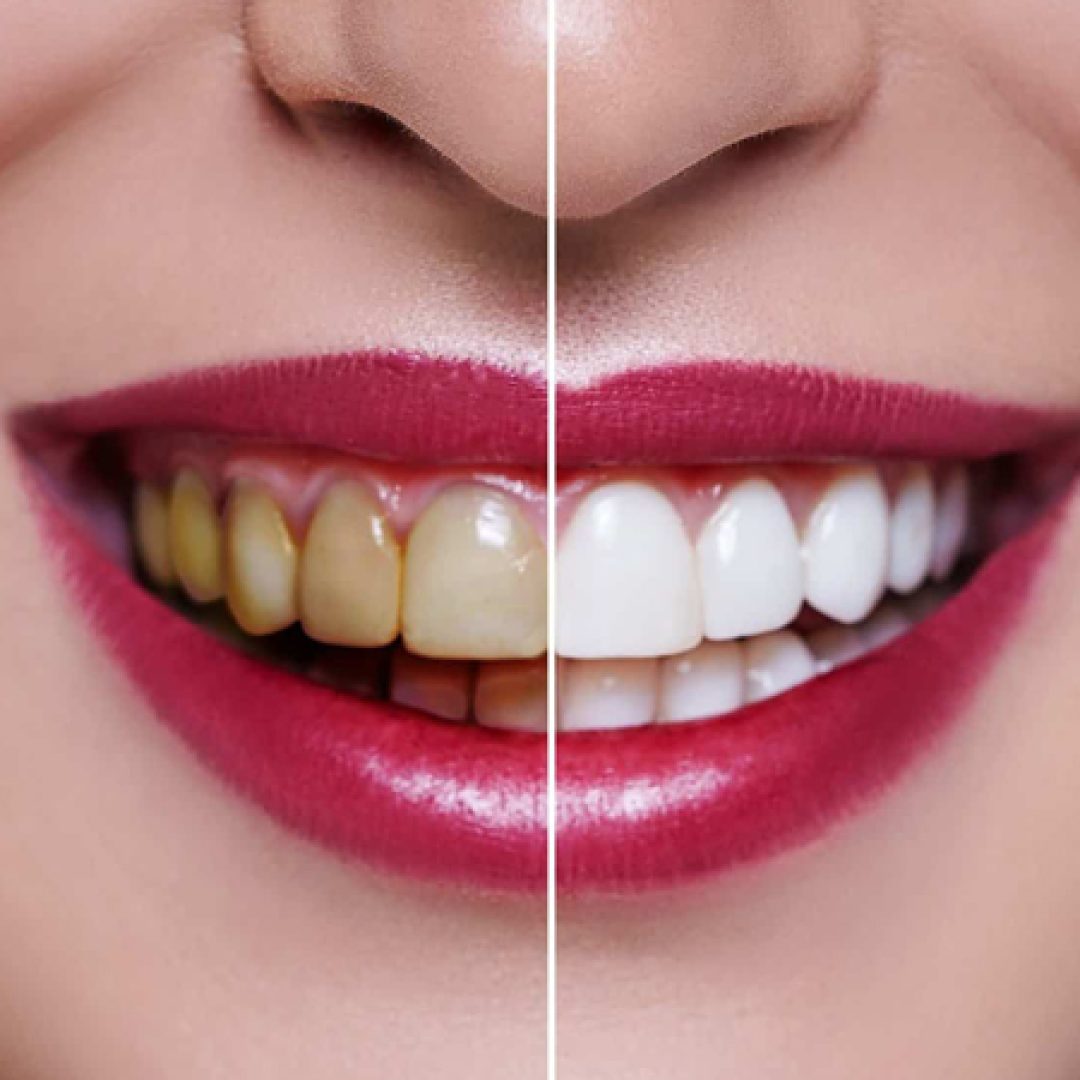 Teeth-Whitening