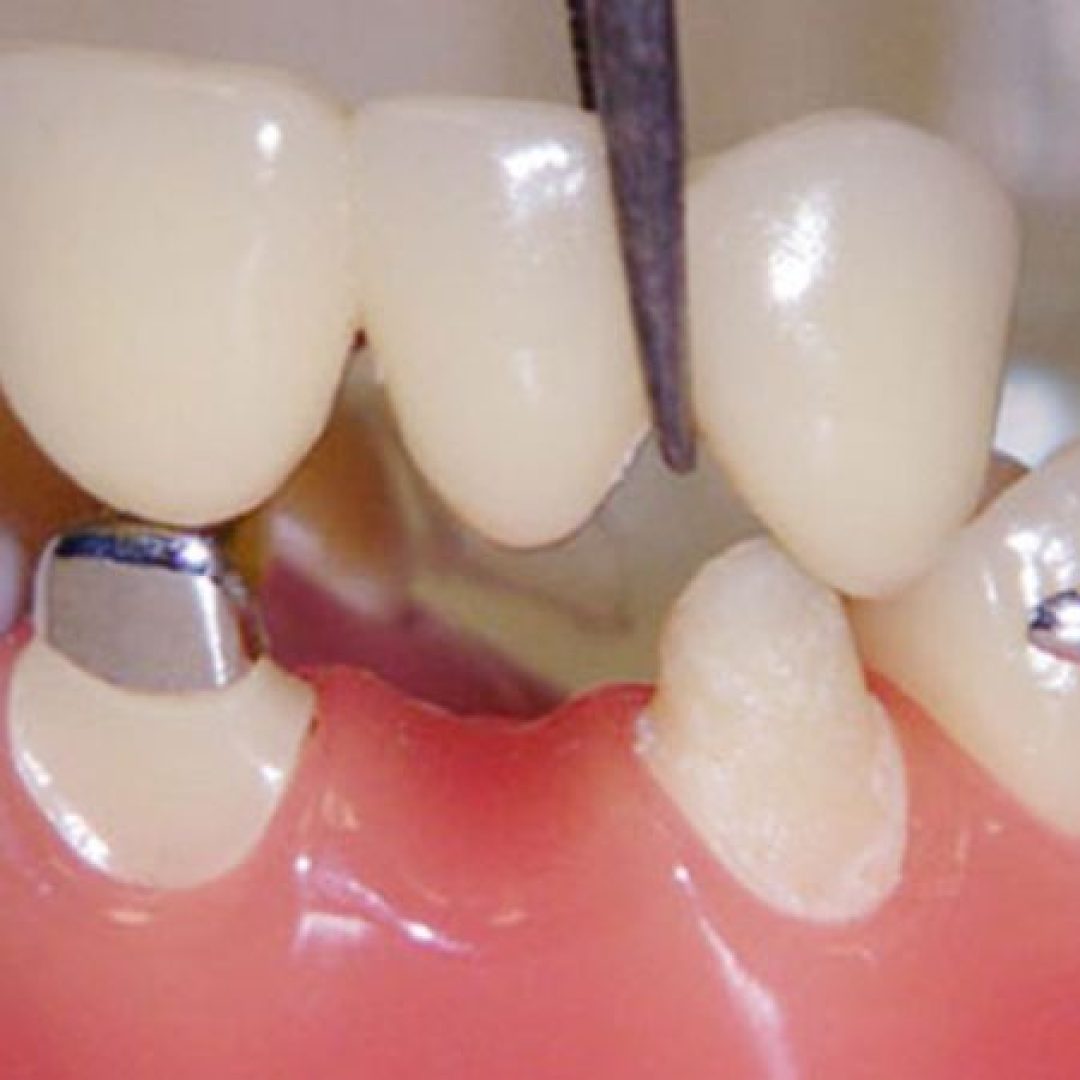 crowns-and-bridges-cosmetic-dentistry